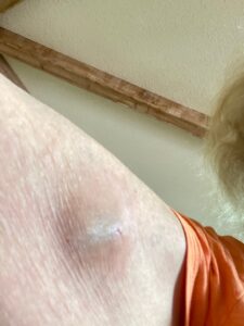 Arm Biopsy - Close-Up